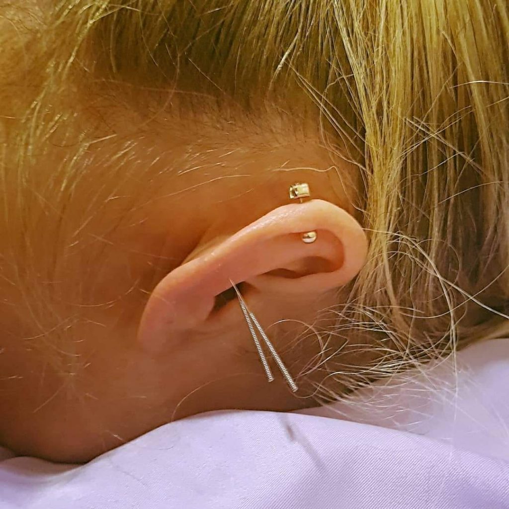 Ear Acupuncture Therapy Dragonstyle Dublin